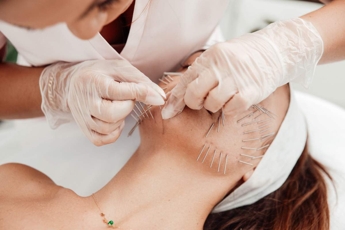 Wkłuwanie igieł podczas zabiegu needle shaping jest bezbolesne dzięki znieczuleniu miejscowemu