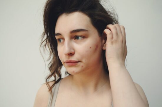 Kobieta boryka się z trądzikiem, który wynika z niskiego poziomu żelaza