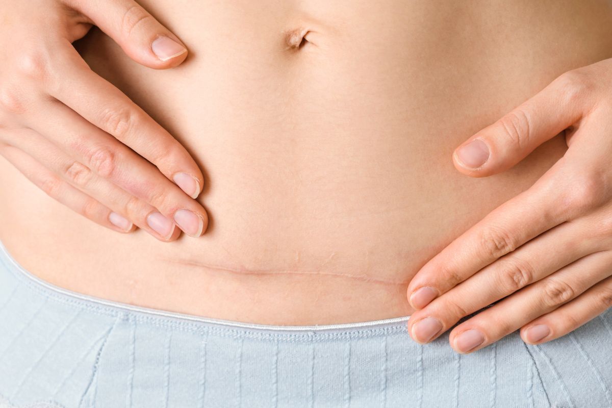 Blizna po cięciu cesarskim