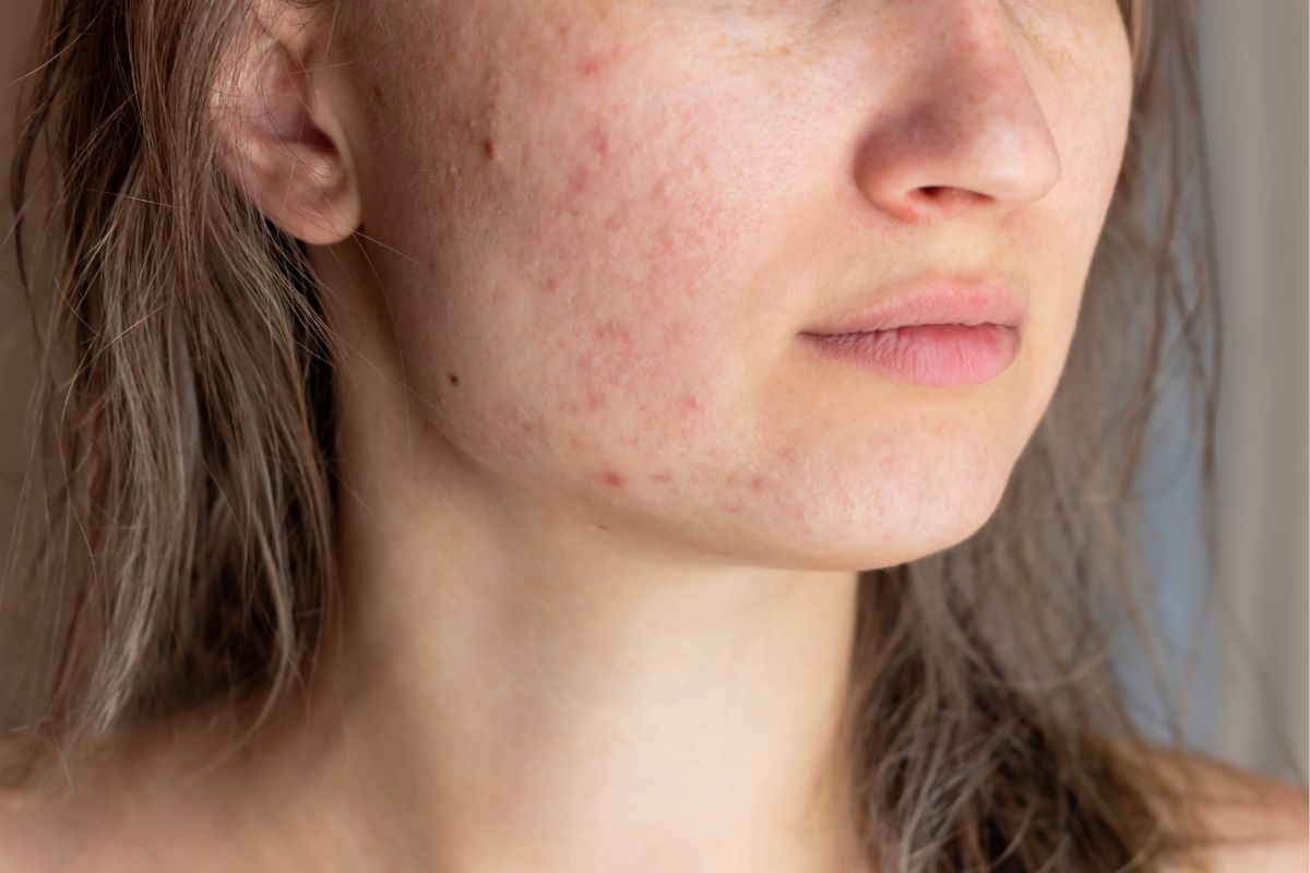 Kobieta z bliznami potrądzikowymi na twarzy