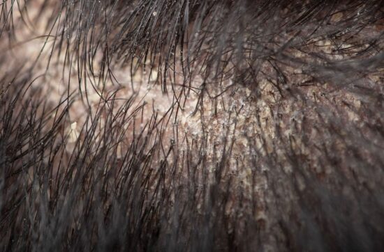 łojotokowe zapalenie skóry głowy