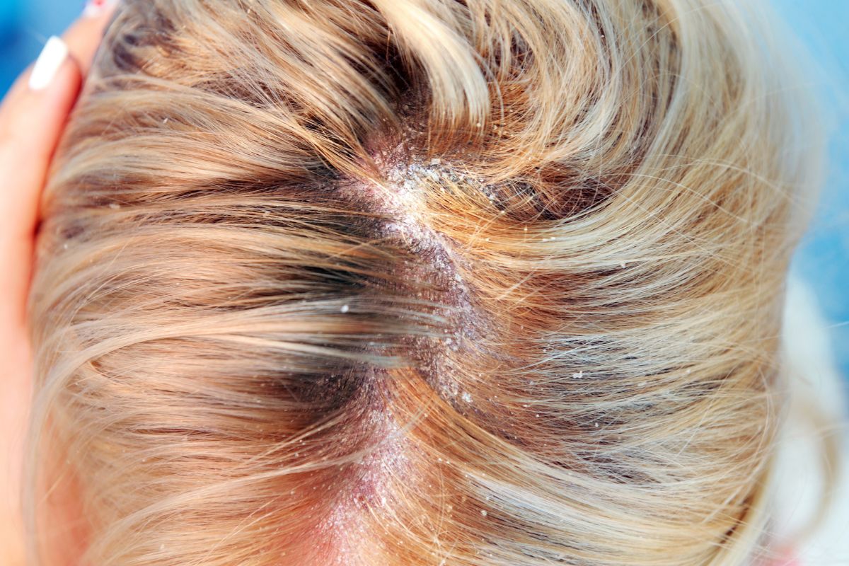 Kobieta ma łojotokowe zapalenie skóry głowy