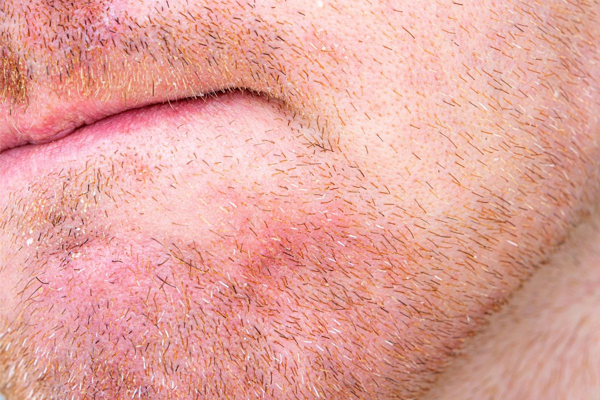 Mężczyzna ma łojotokowe zapalenie skóry twarzy