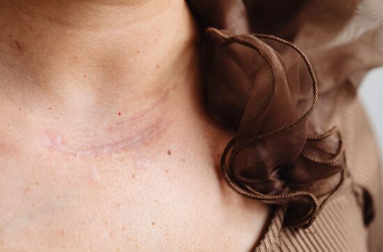 Kobieta z blizną pooperacyjną stosuje maść na blizny